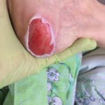 Пролежень 2 стадии